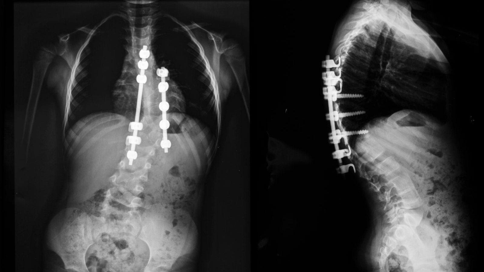 Сколиоз после операции рентген